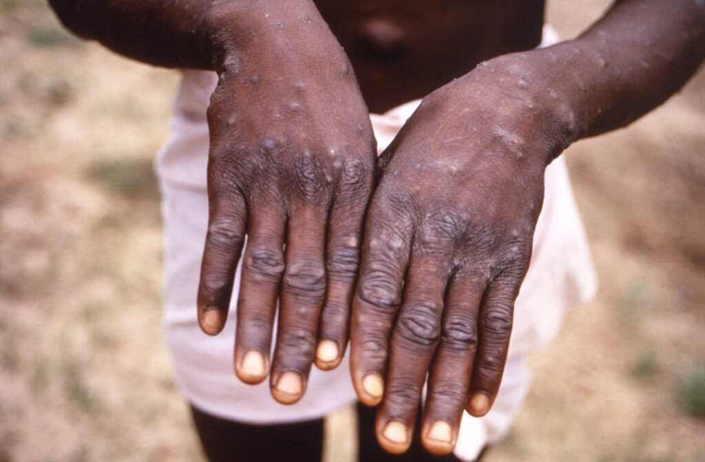 WHO Monkeypox Cases To Rise In NonEndemic Countries CodeBlue